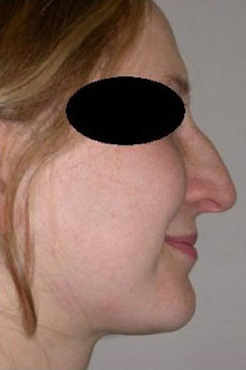 Rhinoplasty Before & After Gallery - Patient 101367 - Image 1