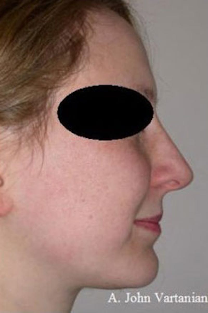 Rhinoplasty Before & After Gallery - Patient 101367 - Image 2