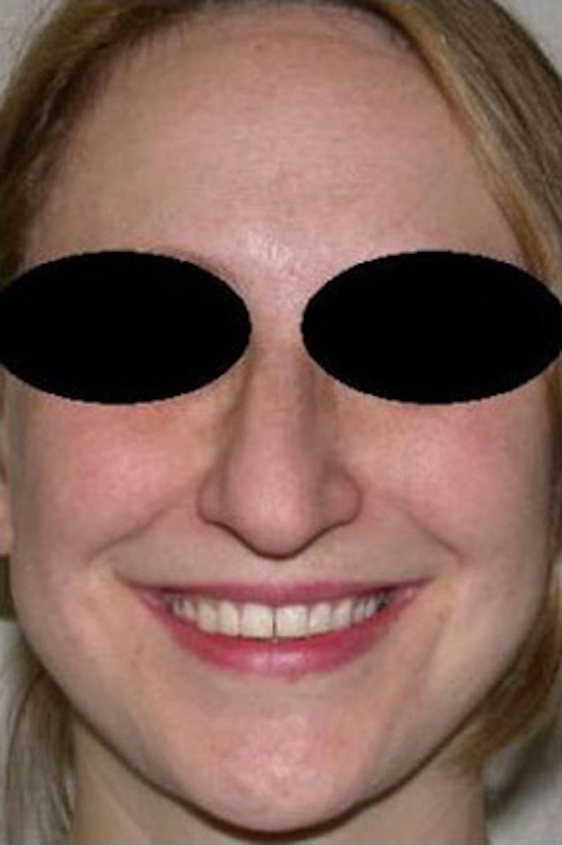 Rhinoplasty Before & After Gallery - Patient 101367 - Image 3