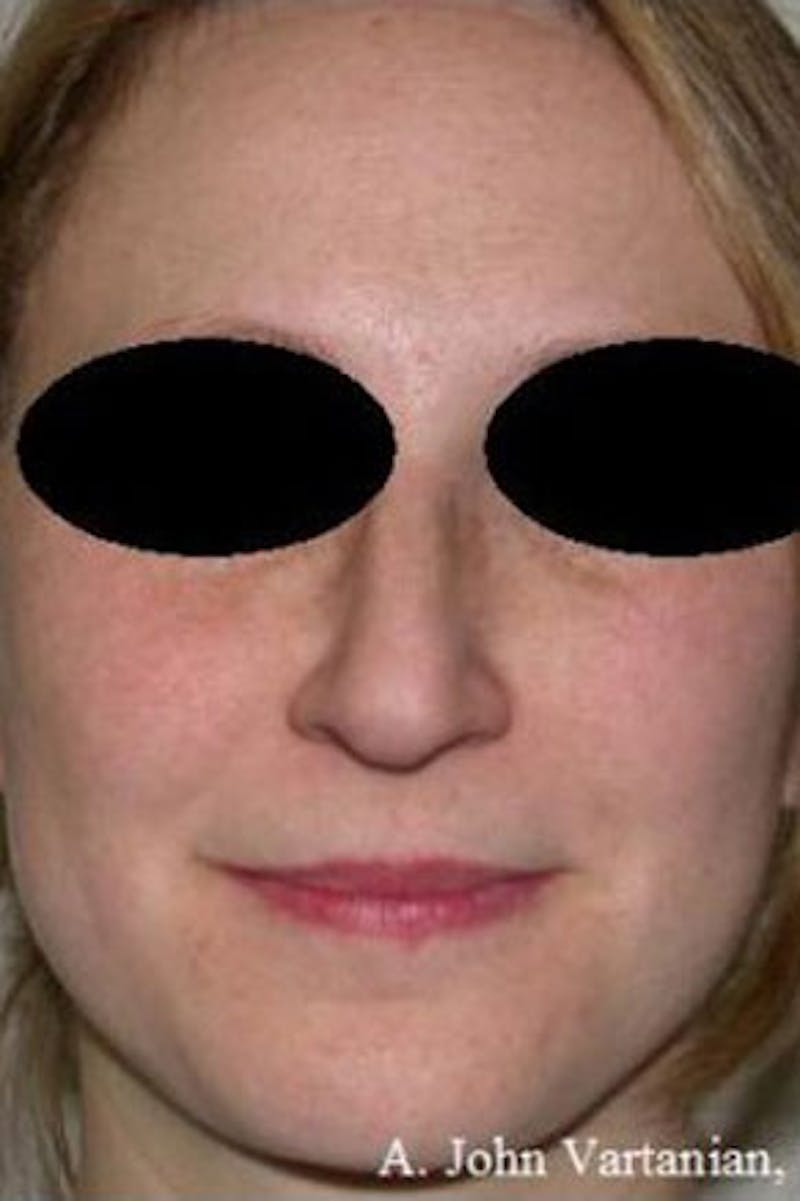 Rhinoplasty Before & After Gallery - Patient 101367 - Image 4