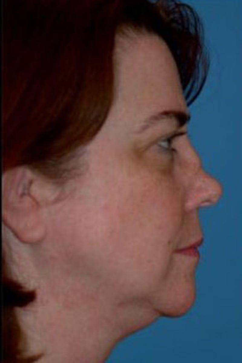 Rhinoplasty Before & After Gallery - Patient 231126 - Image 1