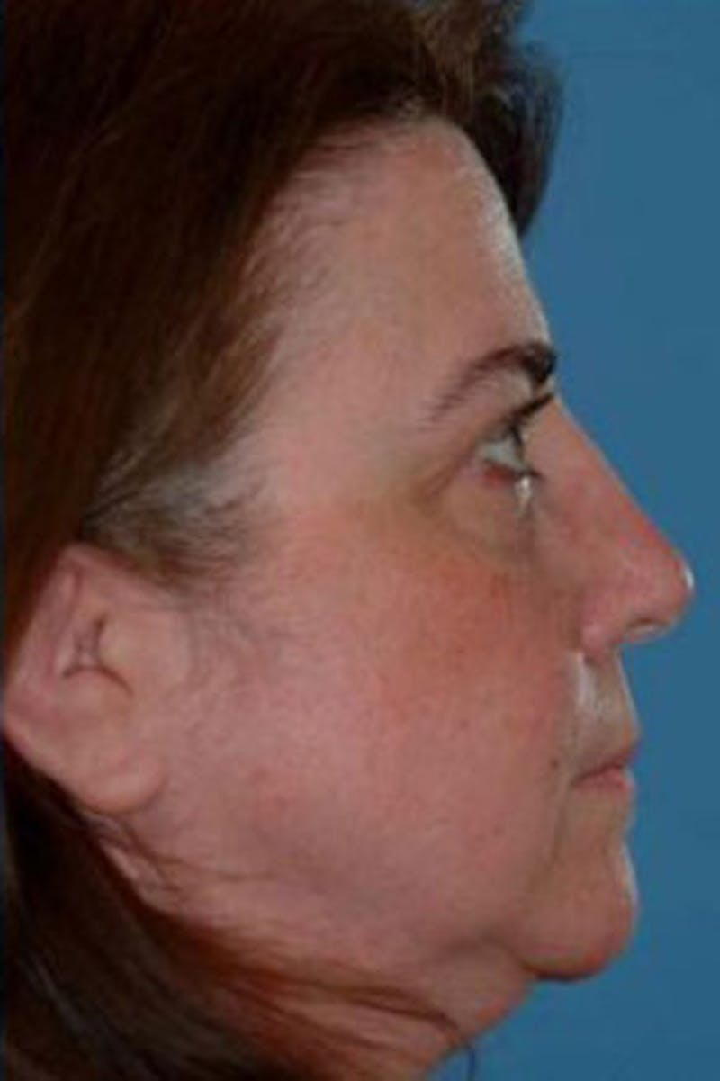 Rhinoplasty Before & After Gallery - Patient 231126 - Image 2