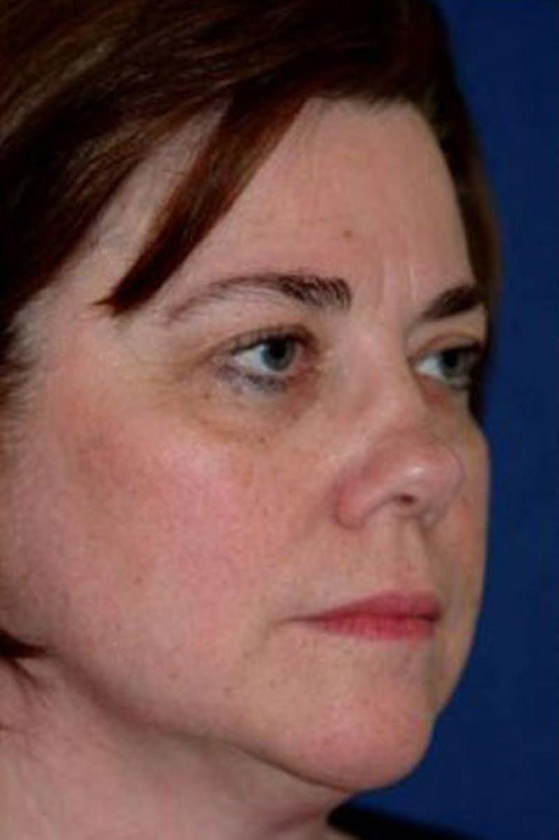 Rhinoplasty Before & After Gallery - Patient 231126 - Image 3