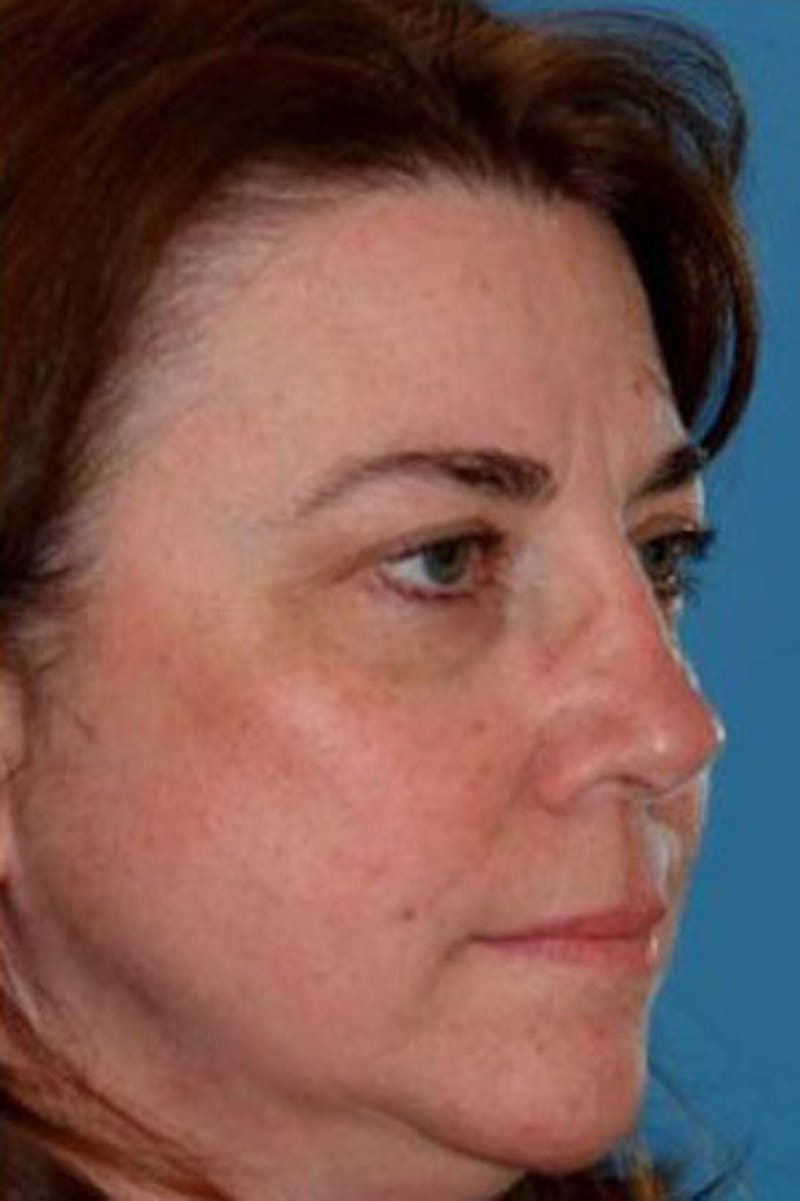 Rhinoplasty Before & After Gallery - Patient 231126 - Image 4