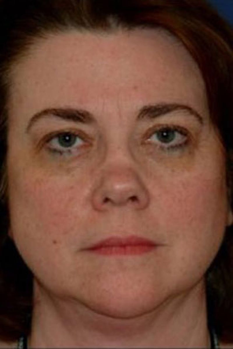 Rhinoplasty Before & After Gallery - Patient 231126 - Image 5