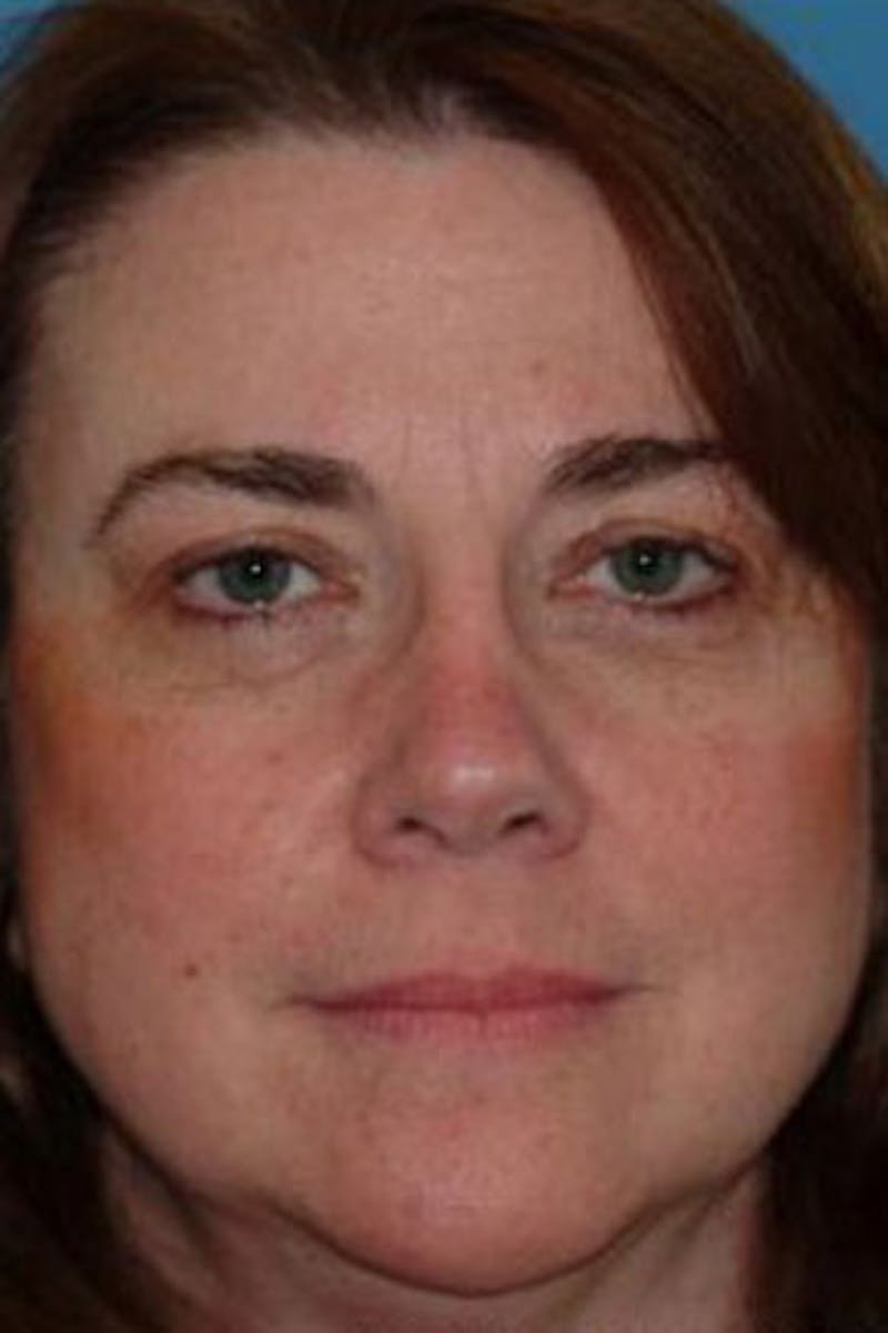 Rhinoplasty Before & After Gallery - Patient 231126 - Image 6