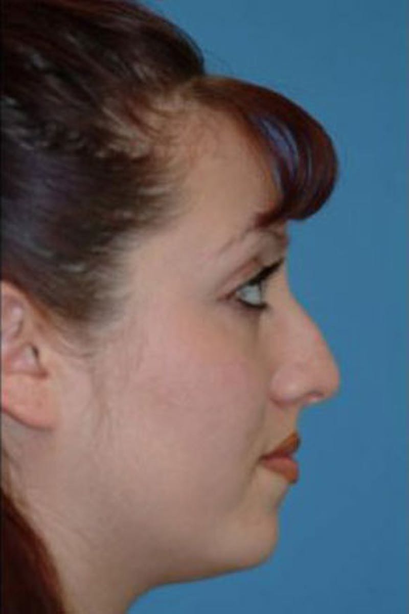 Rhinoplasty Before & After Gallery - Patient 426931 - Image 1