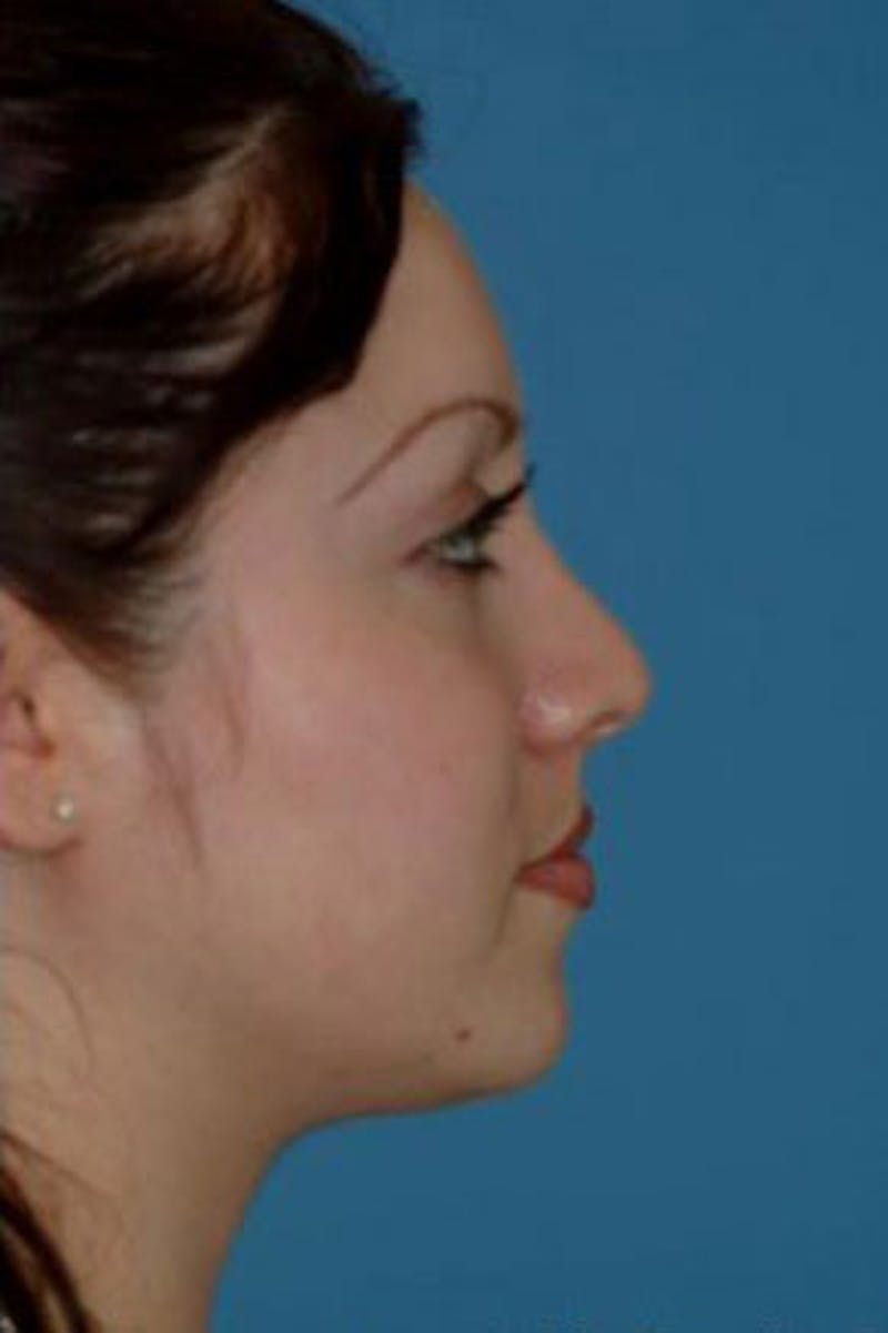 Rhinoplasty Before & After Gallery - Patient 426931 - Image 2