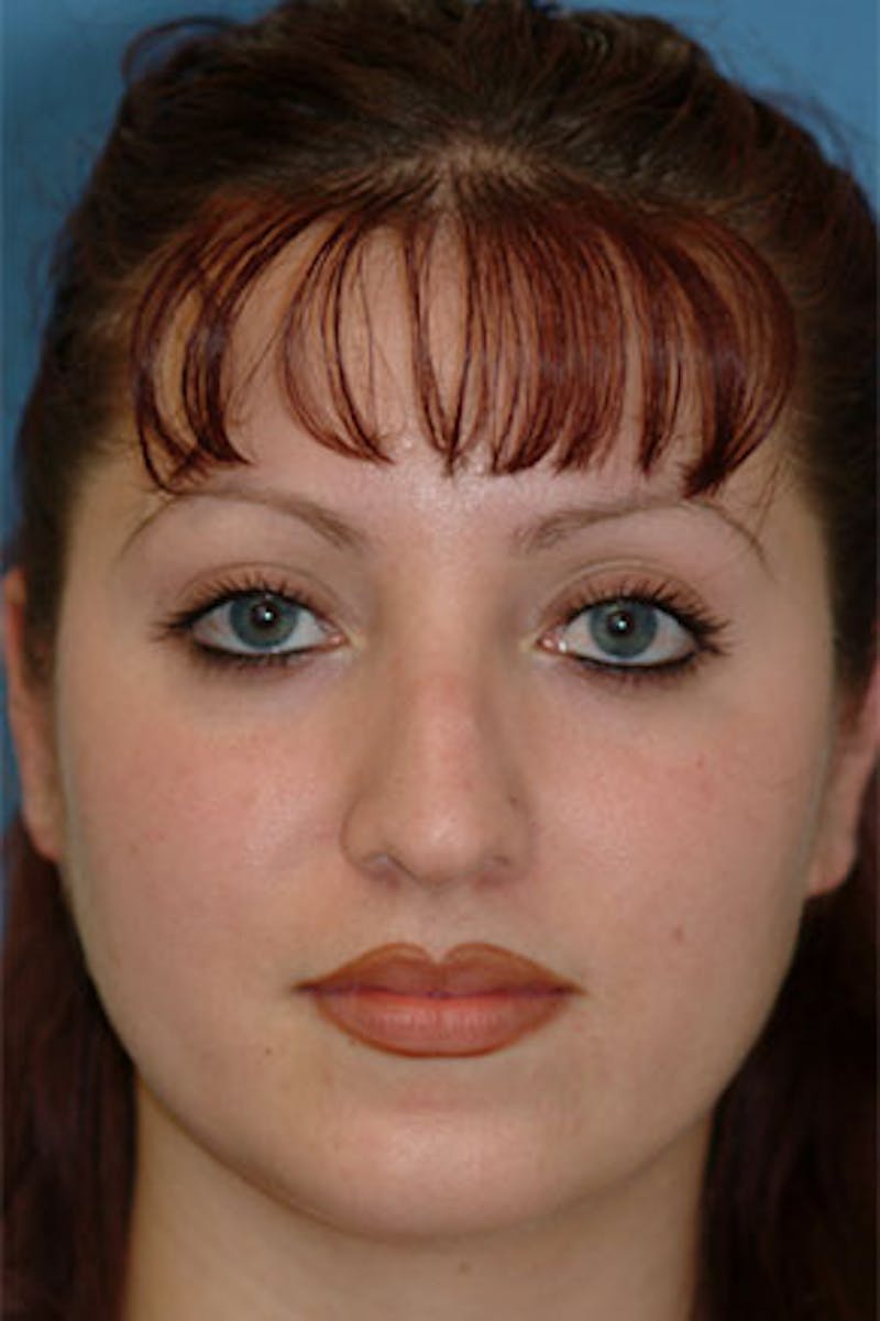 Rhinoplasty Before & After Gallery - Patient 426931 - Image 3