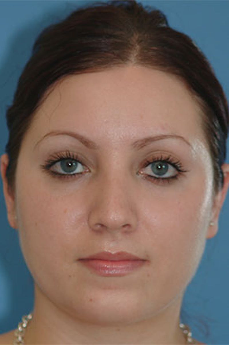 Rhinoplasty Before & After Gallery - Patient 426931 - Image 4