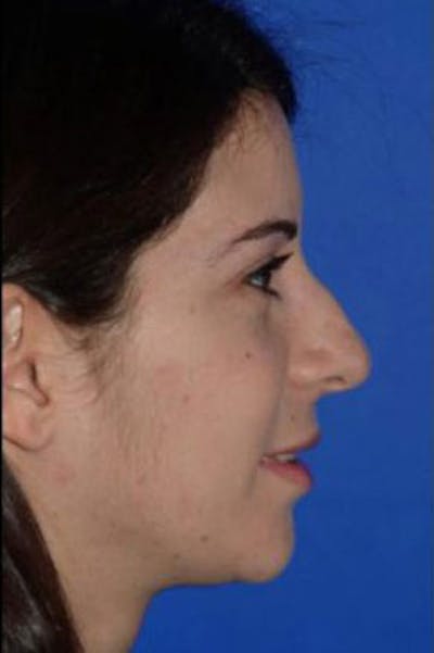 Rhinoplasty Before & After Gallery - Patient 409505 - Image 1