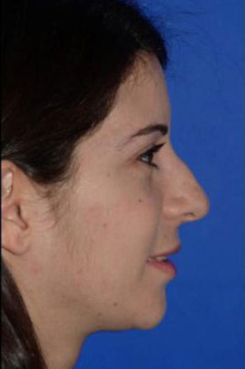 Rhinoplasty Before & After Gallery - Patient 409505 - Image 1
