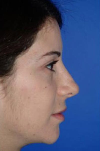 Rhinoplasty Before & After Gallery - Patient 409505 - Image 2