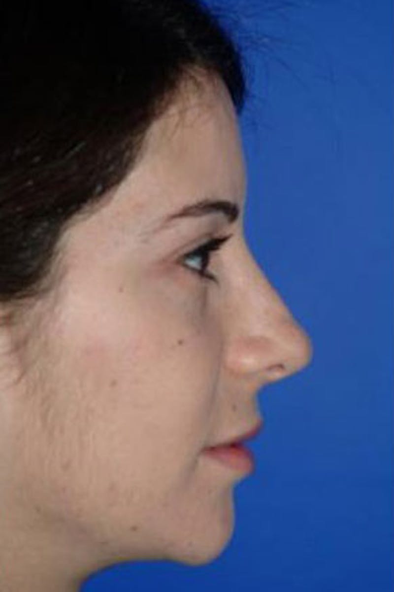 Rhinoplasty Before & After Gallery - Patient 409505 - Image 2