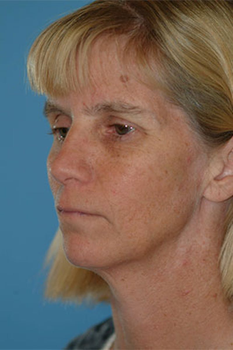 Rhinoplasty Before & After Gallery - Patient 251378 - Image 1