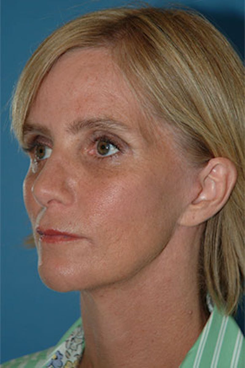 Rhinoplasty Before & After Gallery - Patient 251378 - Image 2