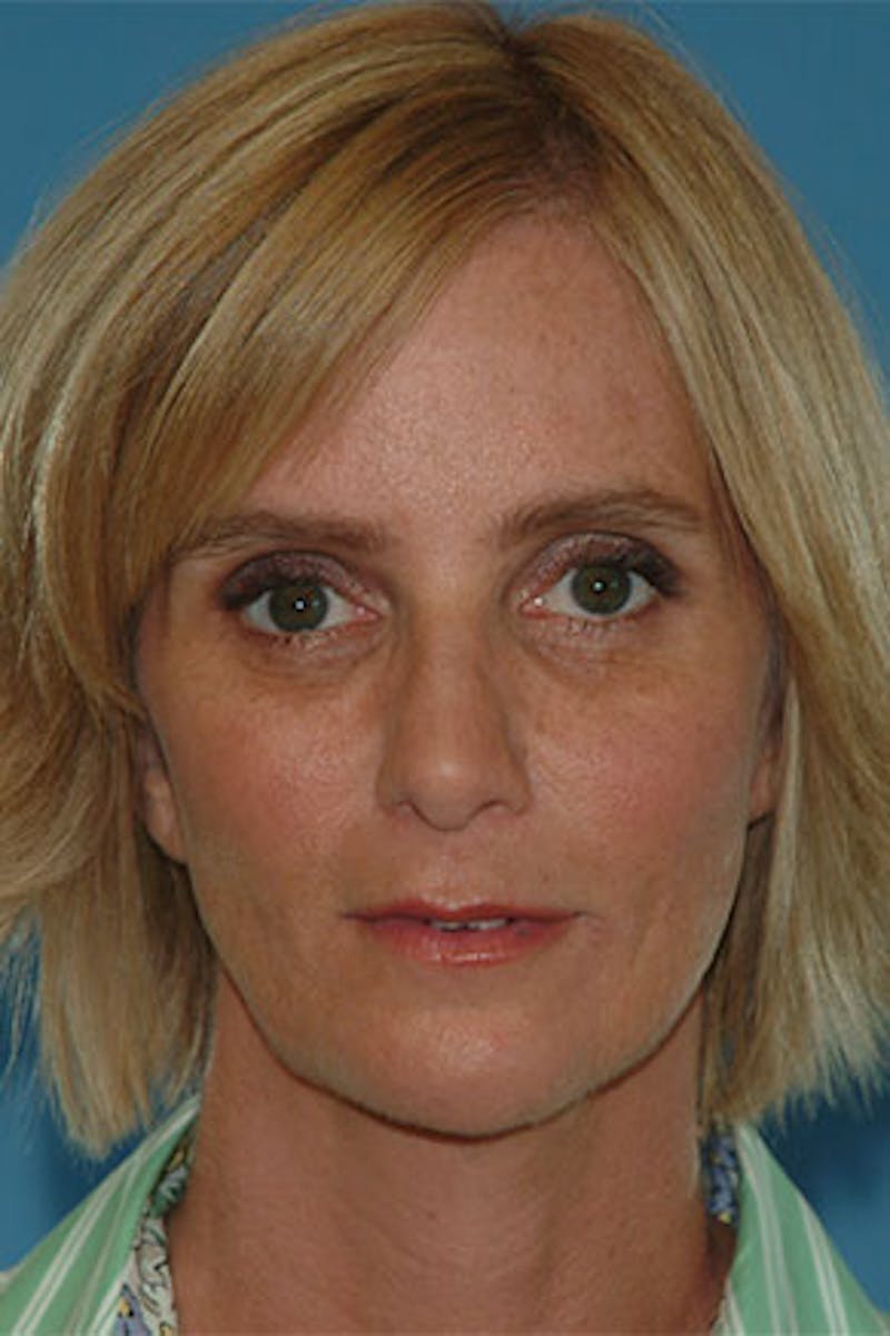 Rhinoplasty Before & After Gallery - Patient 251378 - Image 4