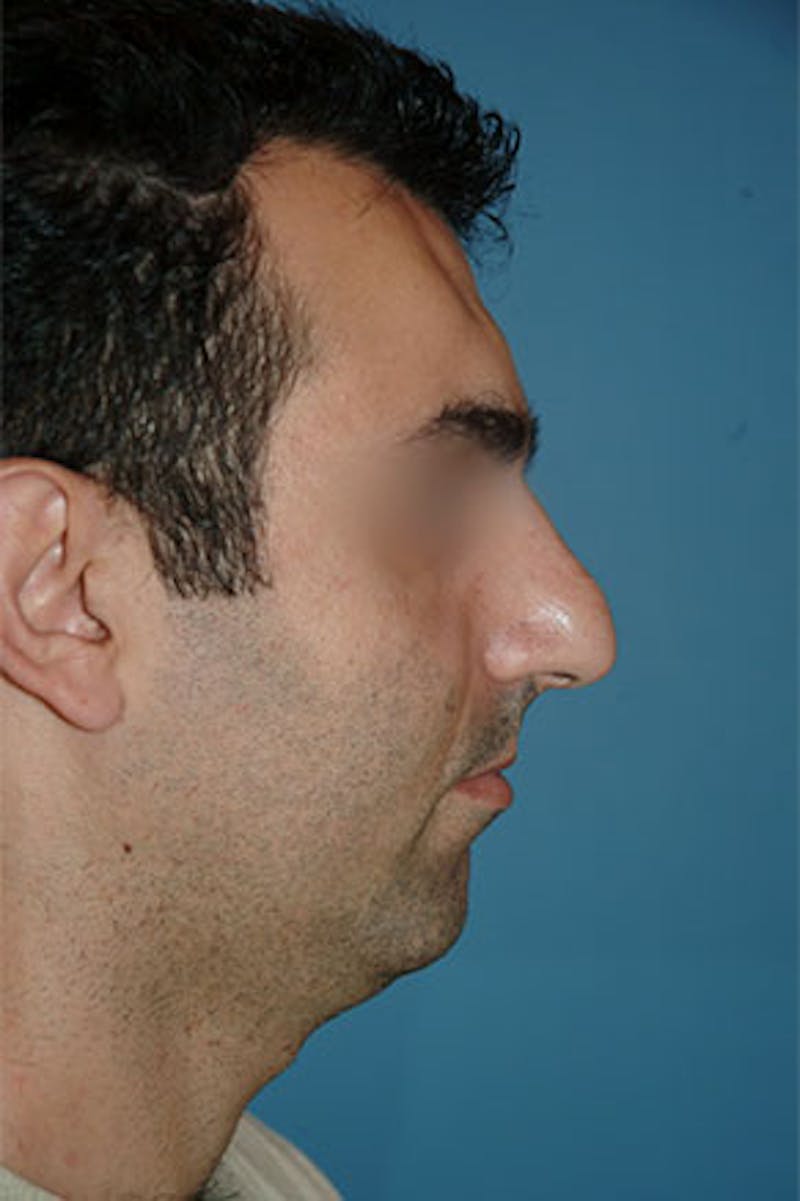 Rhinoplasty Before & After Gallery - Patient 305734 - Image 1
