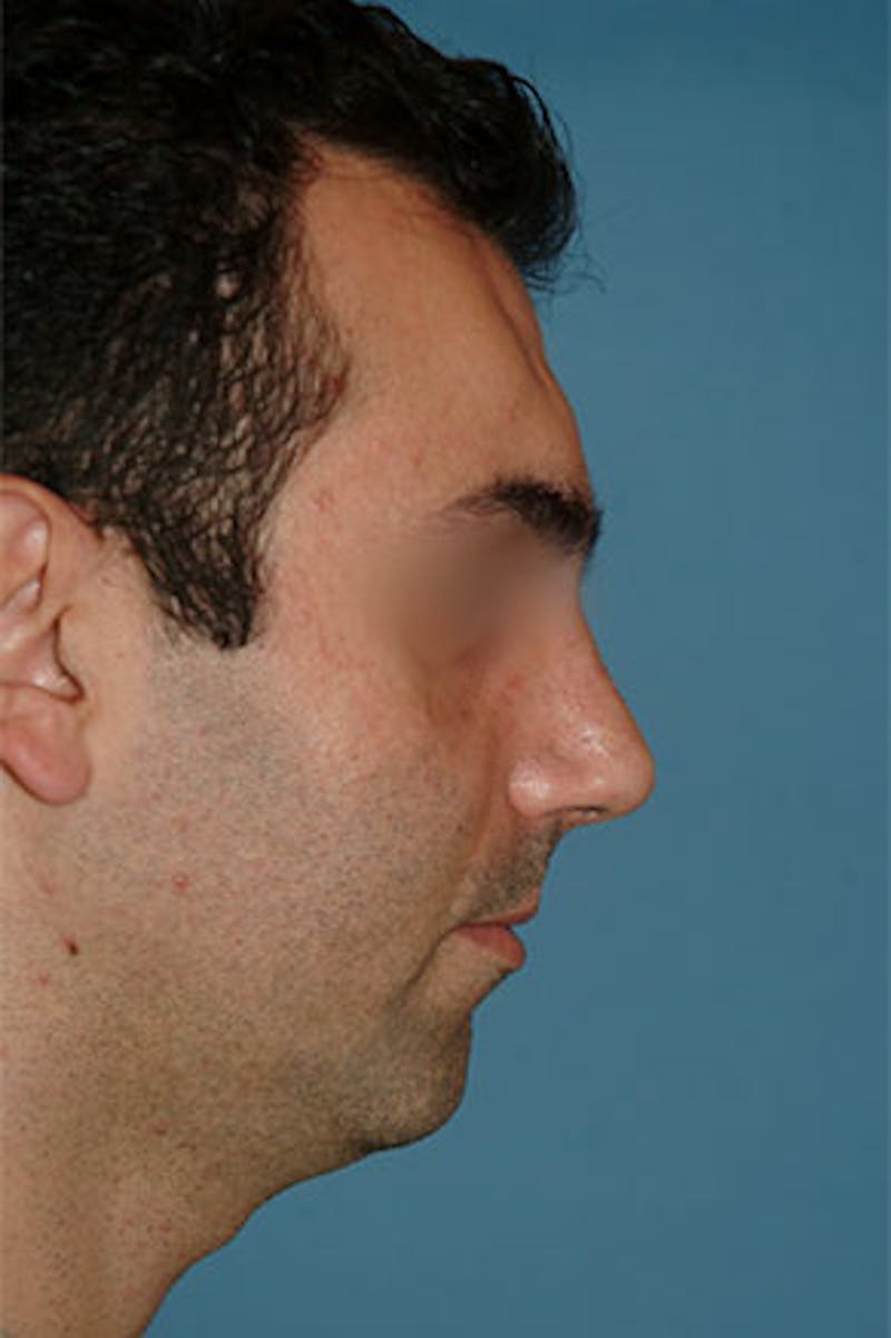 Rhinoplasty Before & After Gallery - Patient 305734 - Image 2