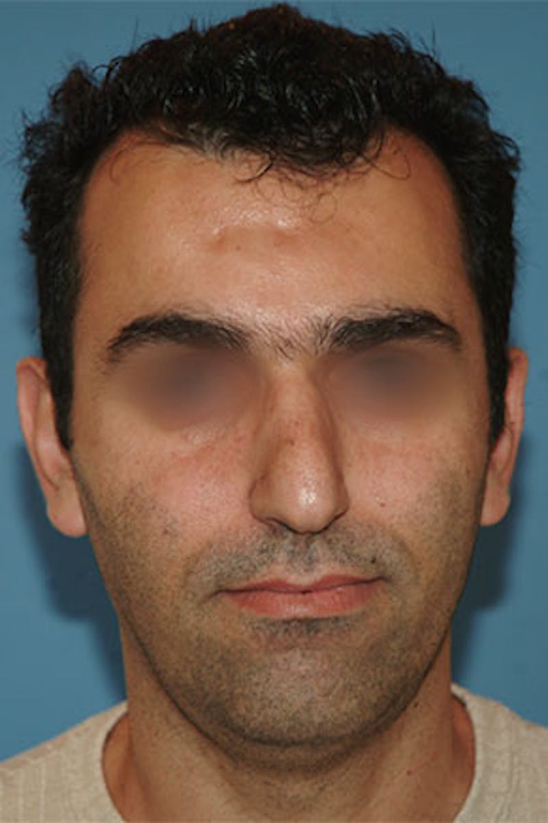 Rhinoplasty Before & After Gallery - Patient 305734 - Image 3
