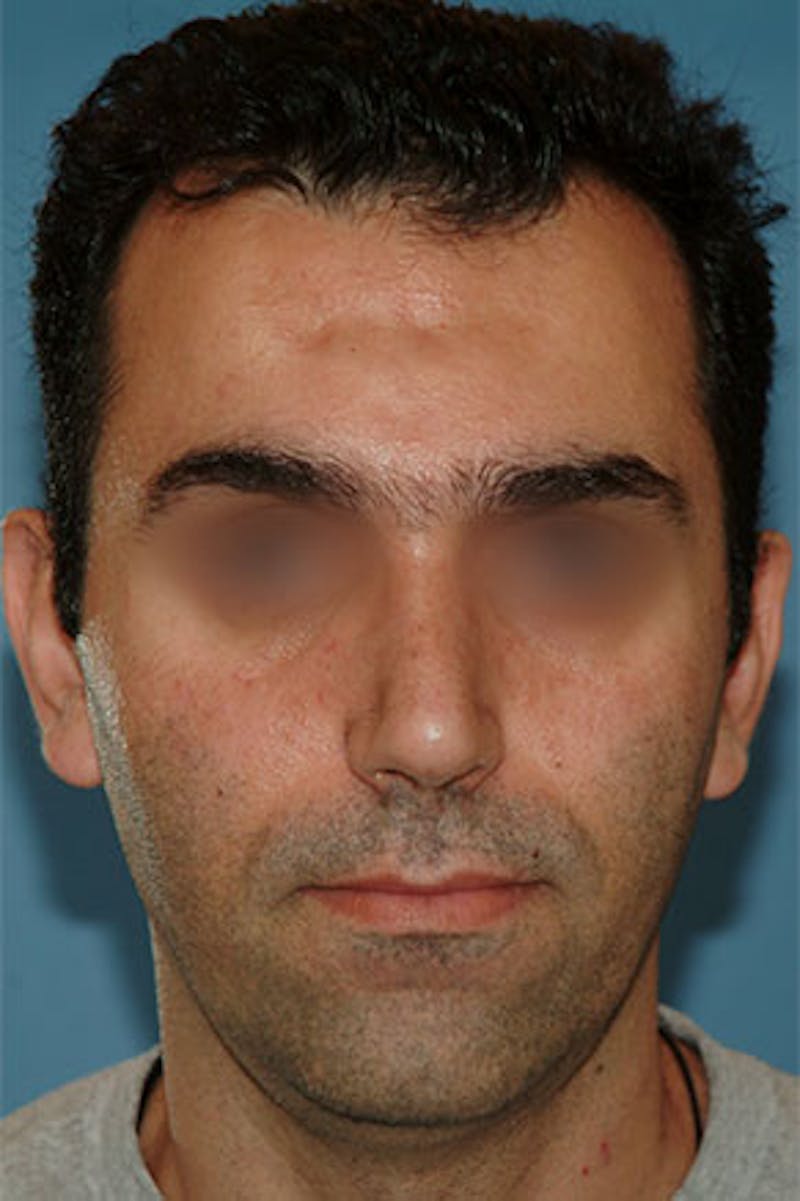 Rhinoplasty Before & After Gallery - Patient 305734 - Image 4