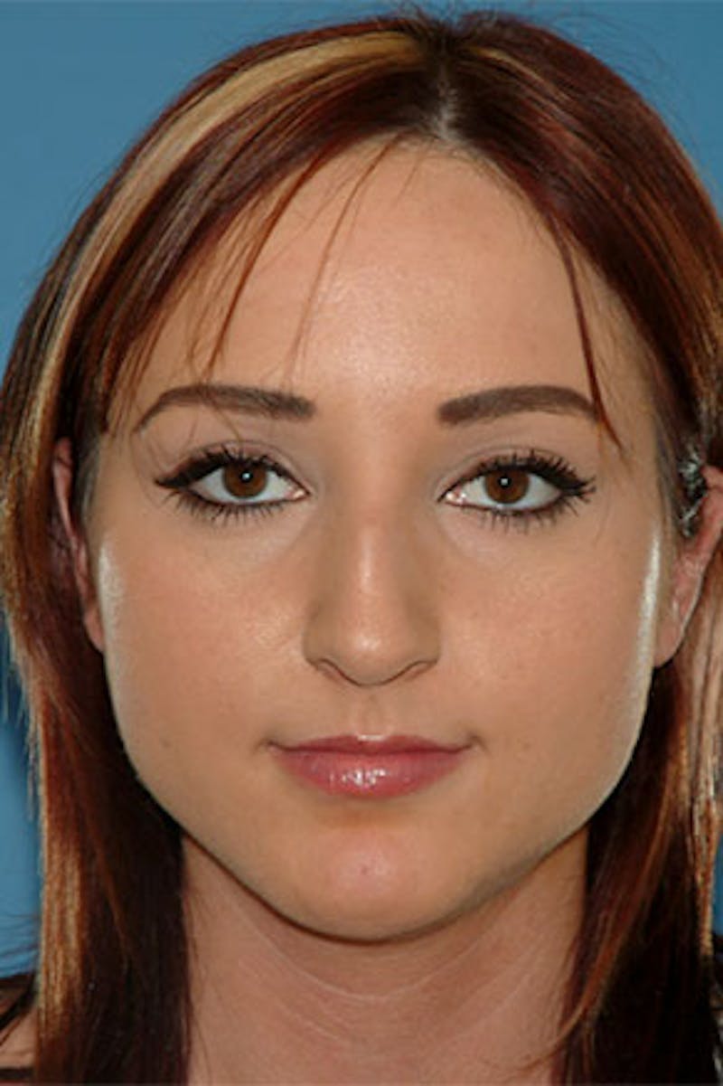Rhinoplasty Before & After Gallery - Patient 164224 - Image 3