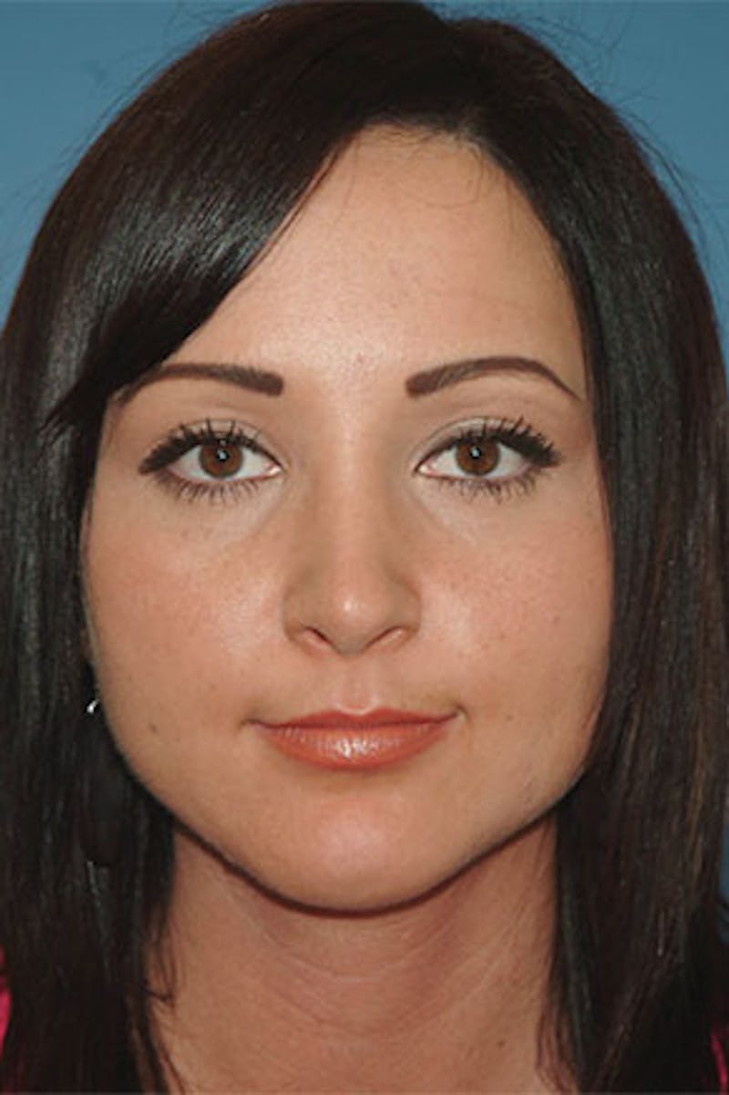 Rhinoplasty Before & After Gallery - Patient 164224 - Image 4