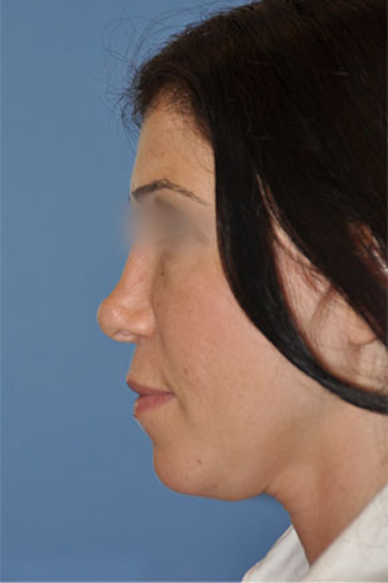Rhinoplasty Before & After Gallery - Patient 270468 - Image 1
