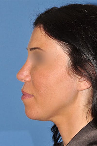Rhinoplasty Before & After Gallery - Patient 270468 - Image 2