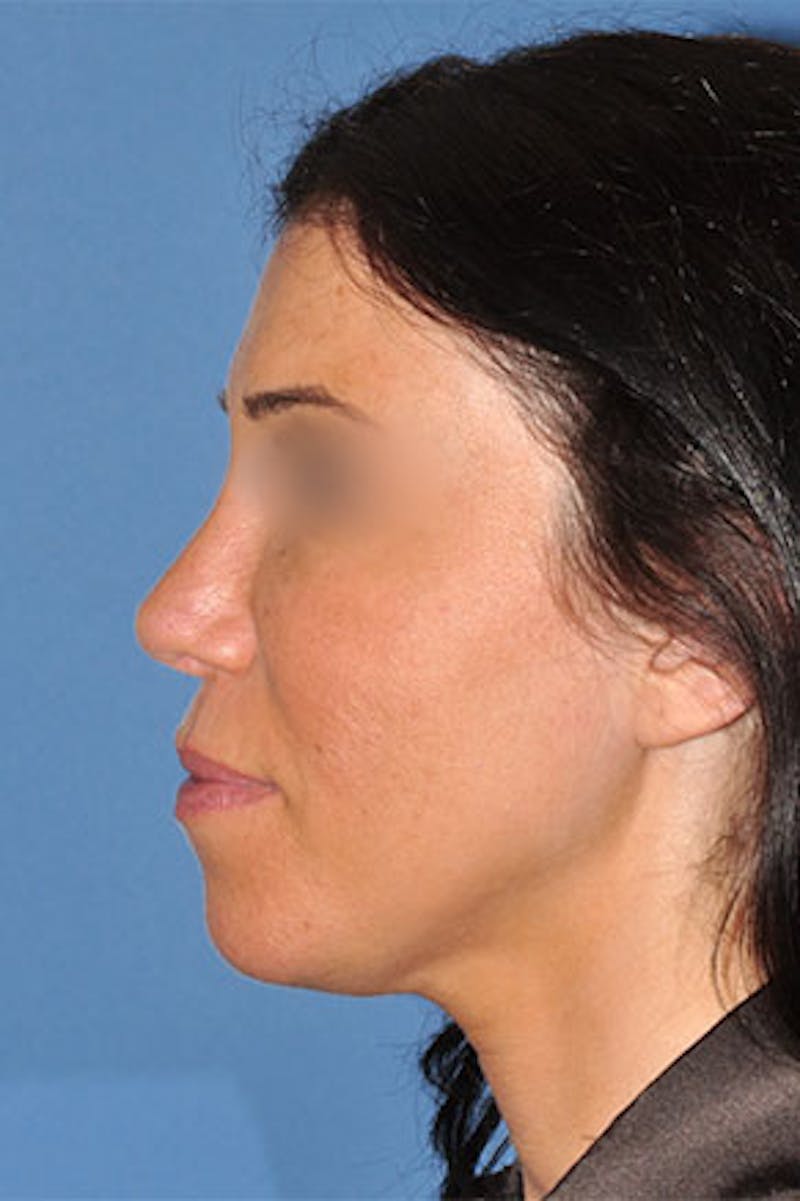 Rhinoplasty Before & After Gallery - Patient 270468 - Image 2
