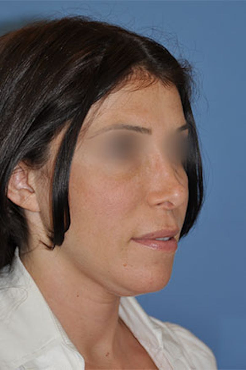 Rhinoplasty Before & After Gallery - Patient 270468 - Image 3