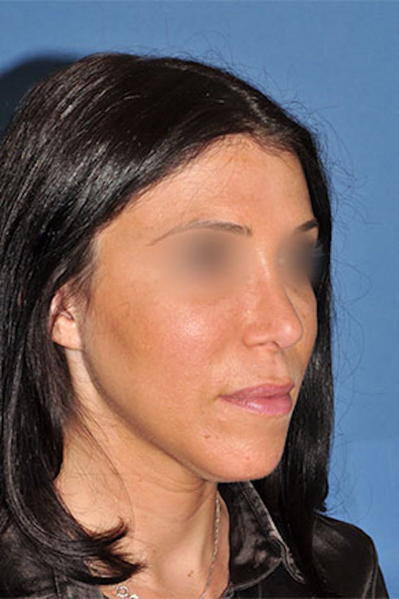 Rhinoplasty Before & After Gallery - Patient 270468 - Image 4