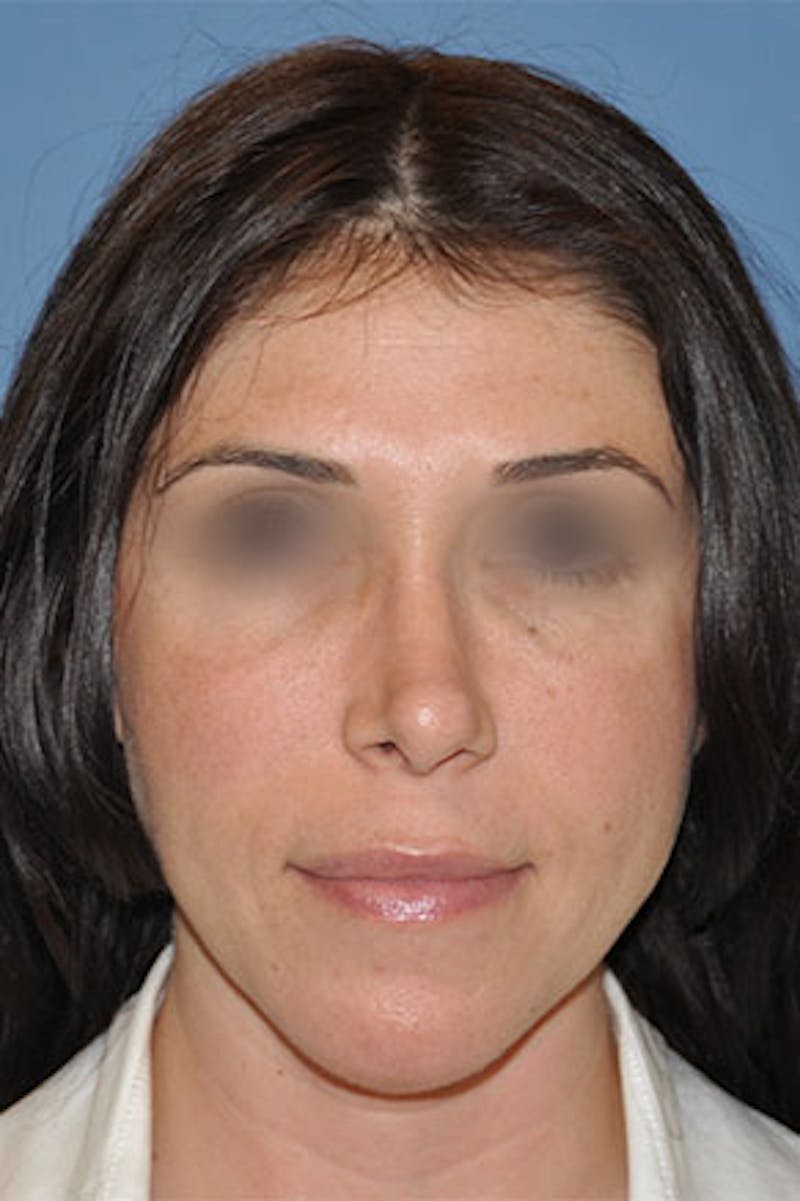 Rhinoplasty Before & After Gallery - Patient 270468 - Image 5