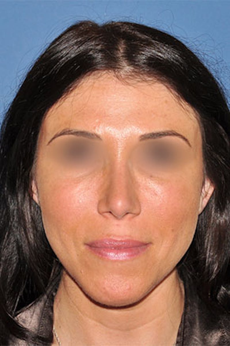 Rhinoplasty Before & After Gallery - Patient 270468 - Image 6
