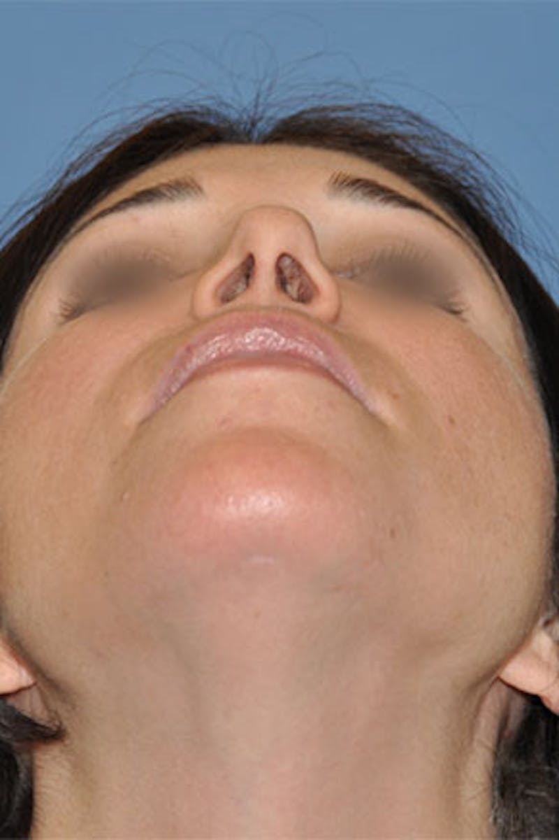 Rhinoplasty Before & After Gallery - Patient 270468 - Image 7