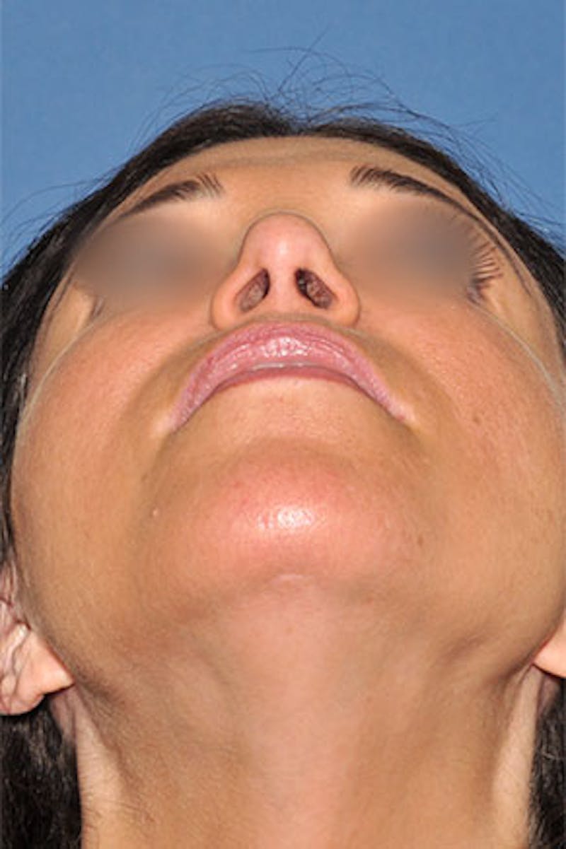 Rhinoplasty Before & After Gallery - Patient 270468 - Image 8