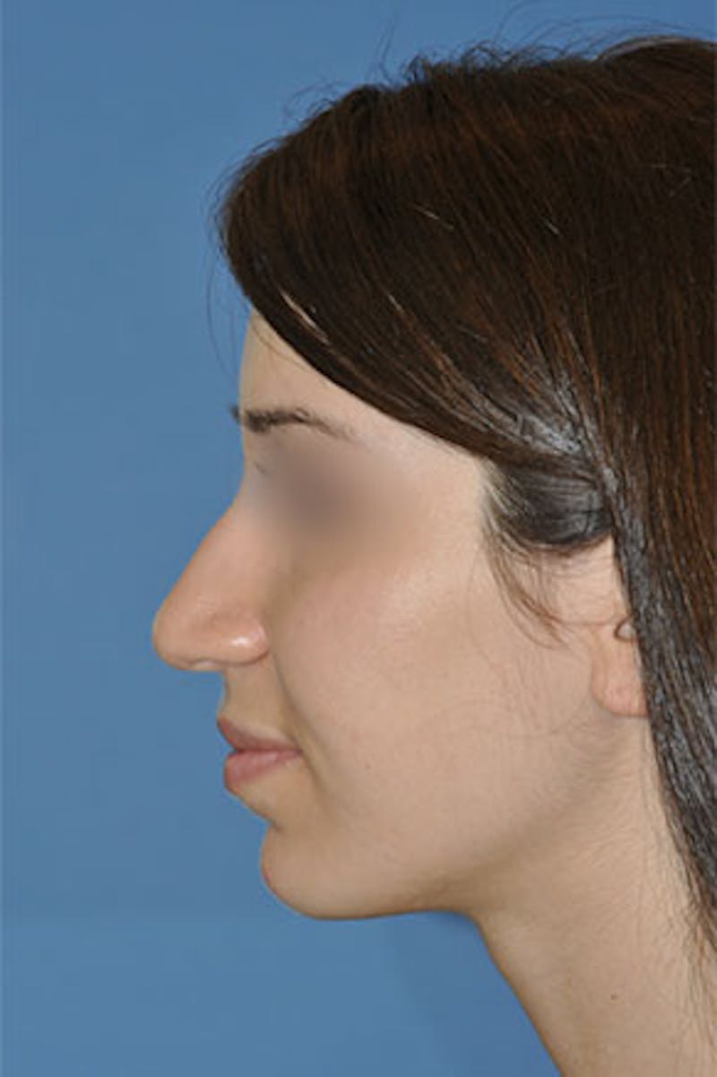 Rhinoplasty Before & After Gallery - Patient 272667 - Image 1