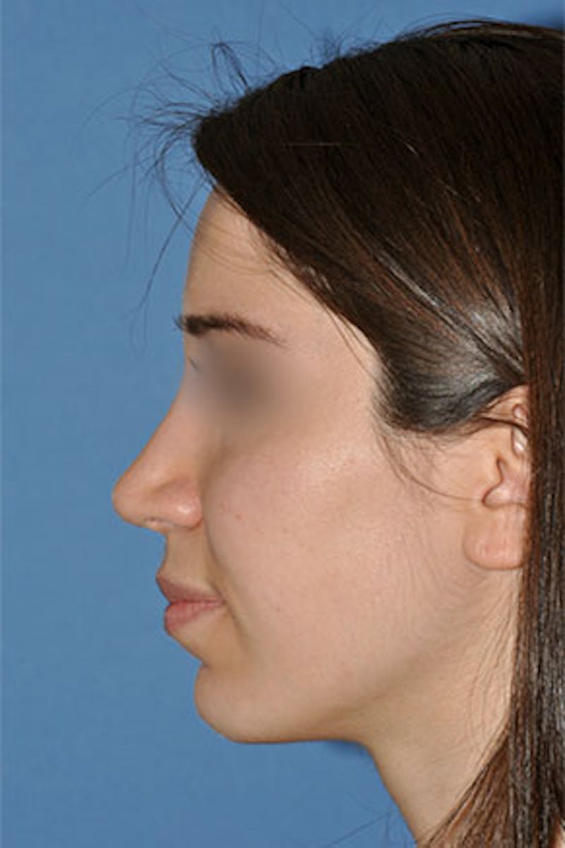 Rhinoplasty Before & After Gallery - Patient 272667 - Image 2