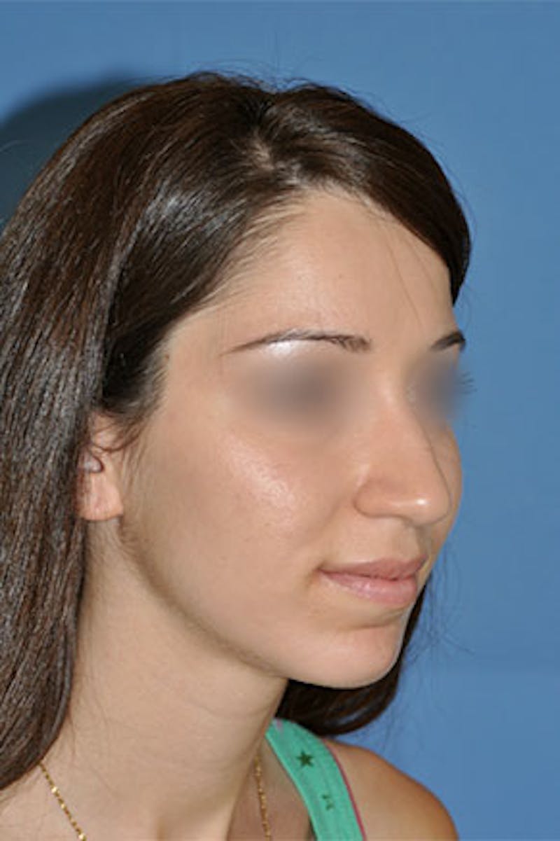 Rhinoplasty Before & After Gallery - Patient 272667 - Image 3