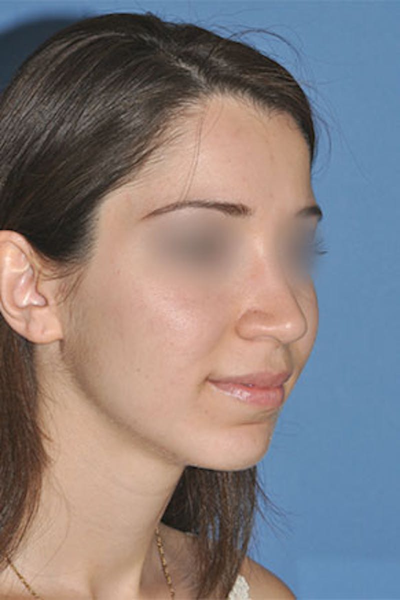 Rhinoplasty Before & After Gallery - Patient 272667 - Image 4