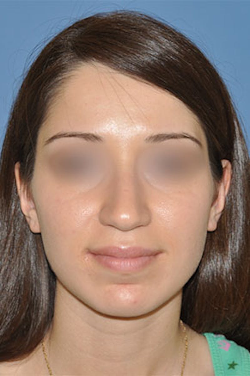 Rhinoplasty Before & After Gallery - Patient 272667 - Image 5