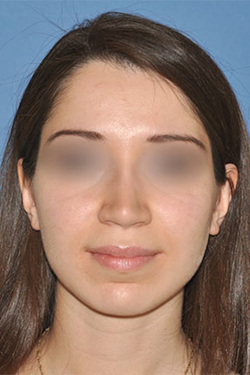 Rhinoplasty Before & After Gallery - Patient 272667 - Image 6