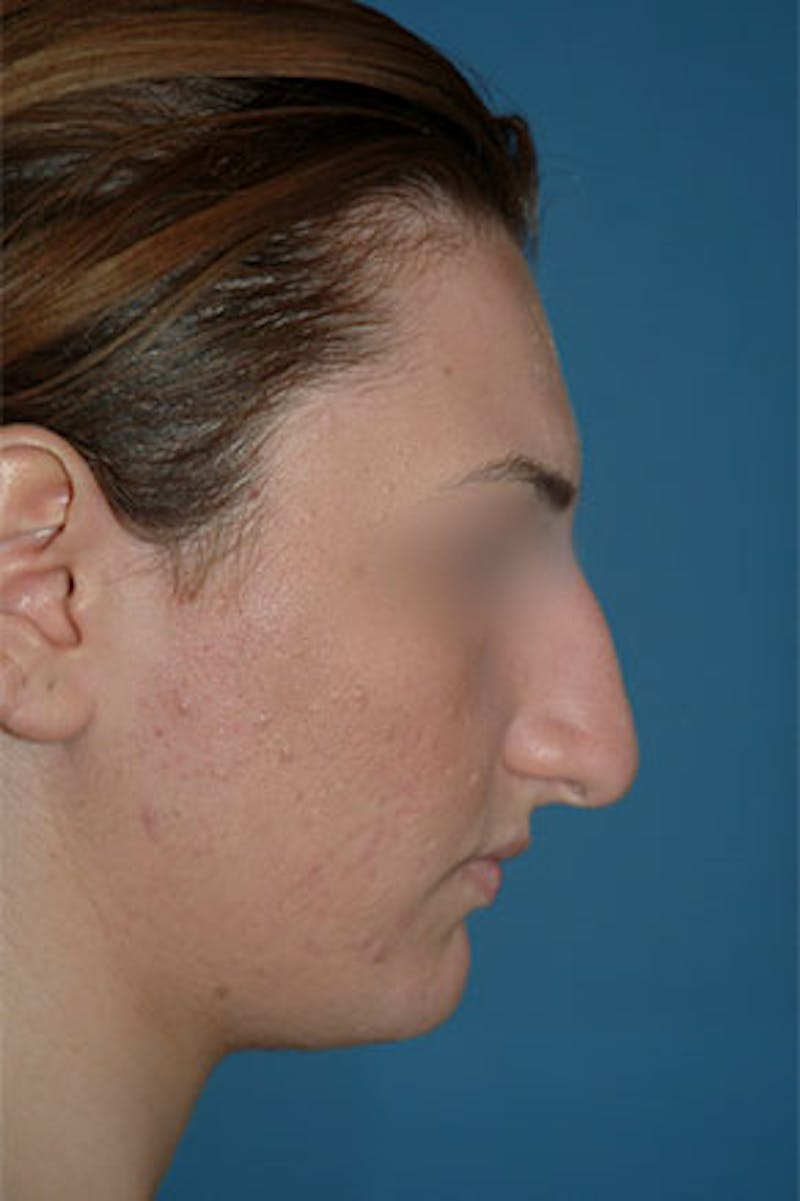 Rhinoplasty Before & After Gallery - Patient 364793 - Image 1