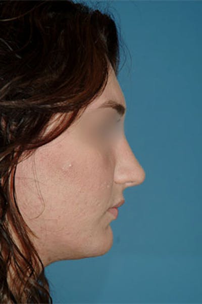 Rhinoplasty Before & After Gallery - Patient 364793 - Image 2