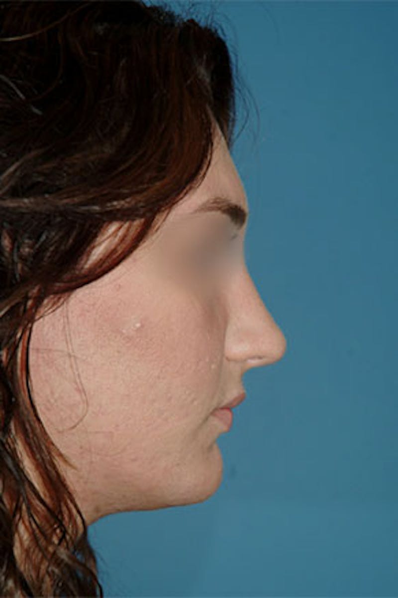 Rhinoplasty Before & After Gallery - Patient 364793 - Image 2