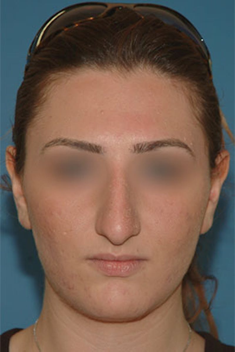 Rhinoplasty Before & After Gallery - Patient 364793 - Image 3