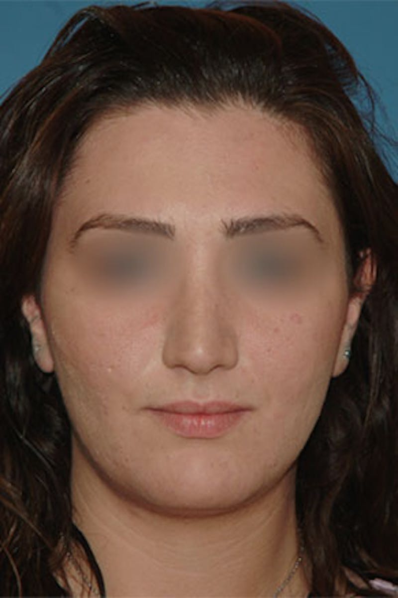Rhinoplasty Before & After Gallery - Patient 364793 - Image 4