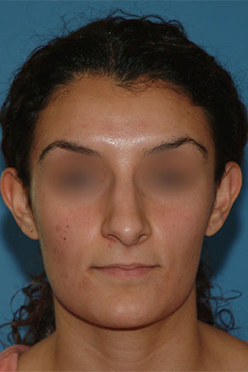 Rhinoplasty Before & After Gallery - Patient 110445 - Image 1