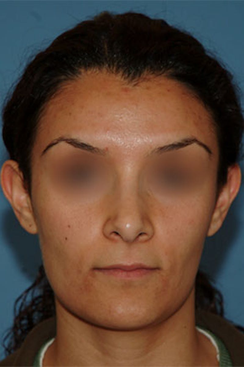 Rhinoplasty Before & After Gallery - Patient 110445 - Image 2