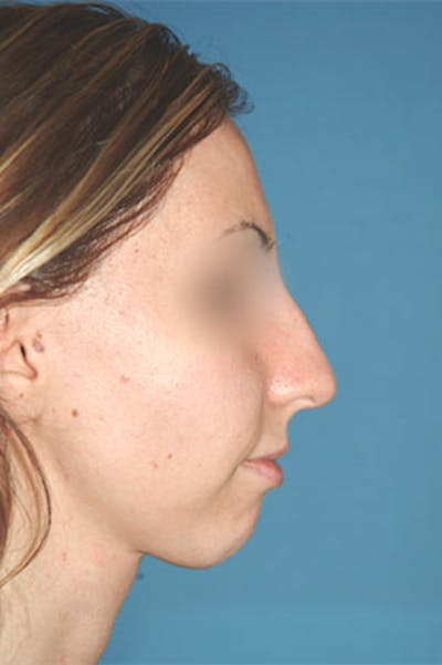 Rhinoplasty Before & After Gallery - Patient 810232 - Image 1